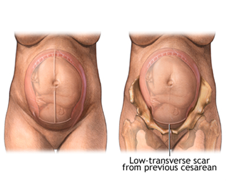 Previous Cesarean Section - Top Pregnancy Doctor in Faridabad