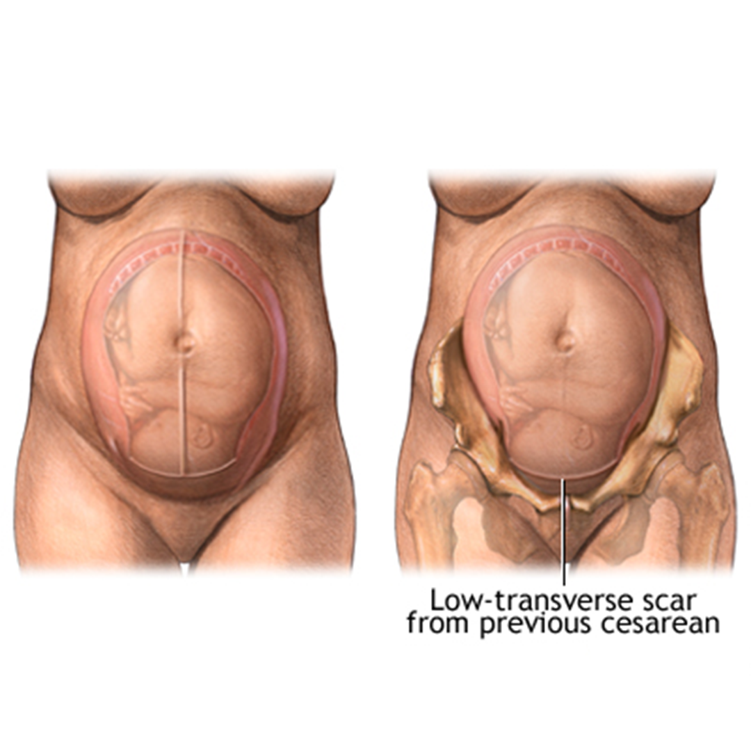 Previous Cesarean Section - Top Pregnancy Doctor in Faridabad