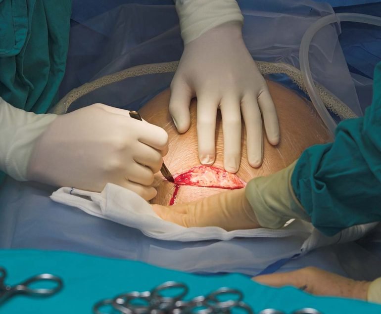 Cesarean Section - Top Gynaecology Doctor in Faridabad