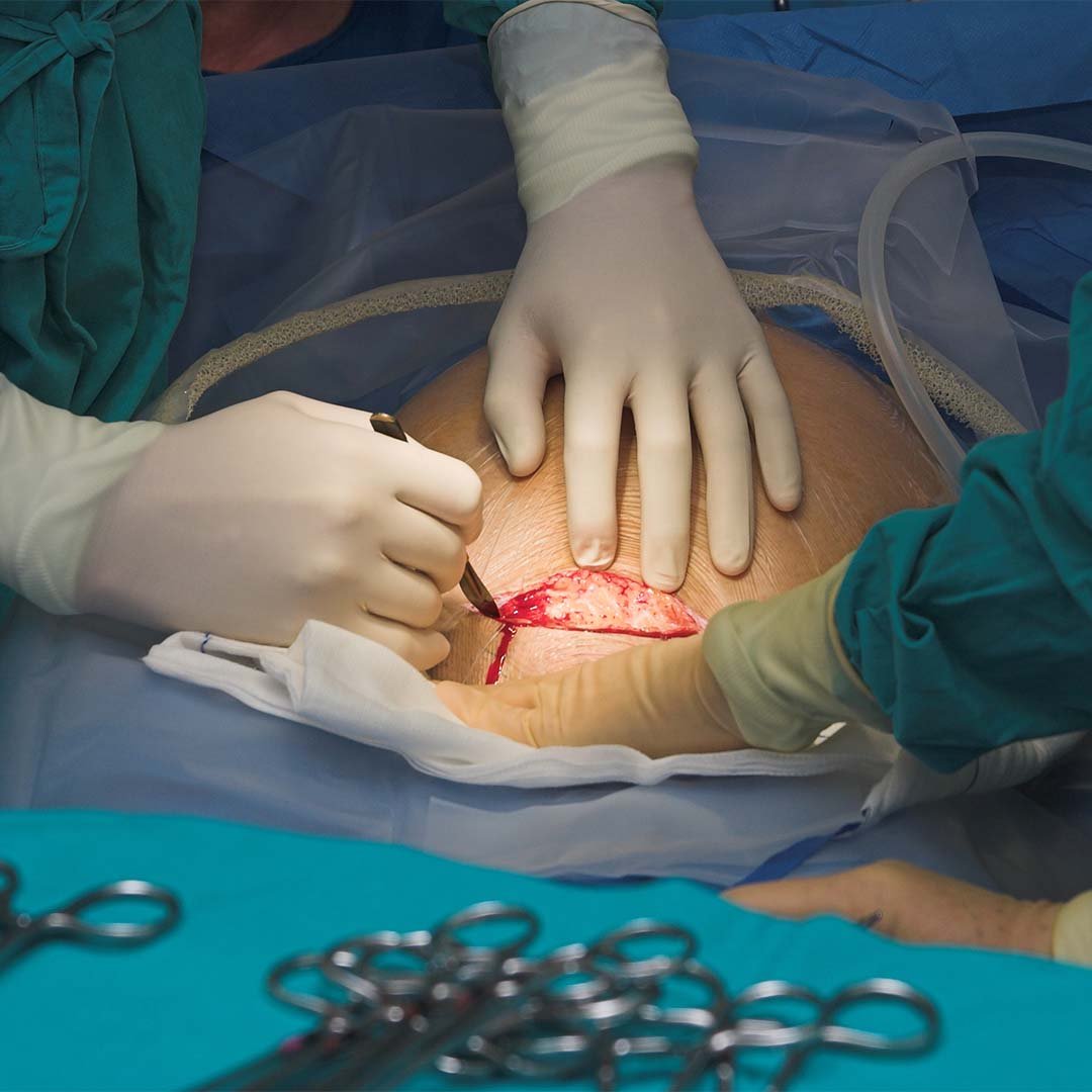 Cesarean Section - Top Gynaecology Doctor in Faridabad