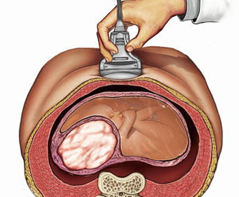 Fibroids in Pregnancy-Best Doctor for Uterine Fibroids in Faridabad