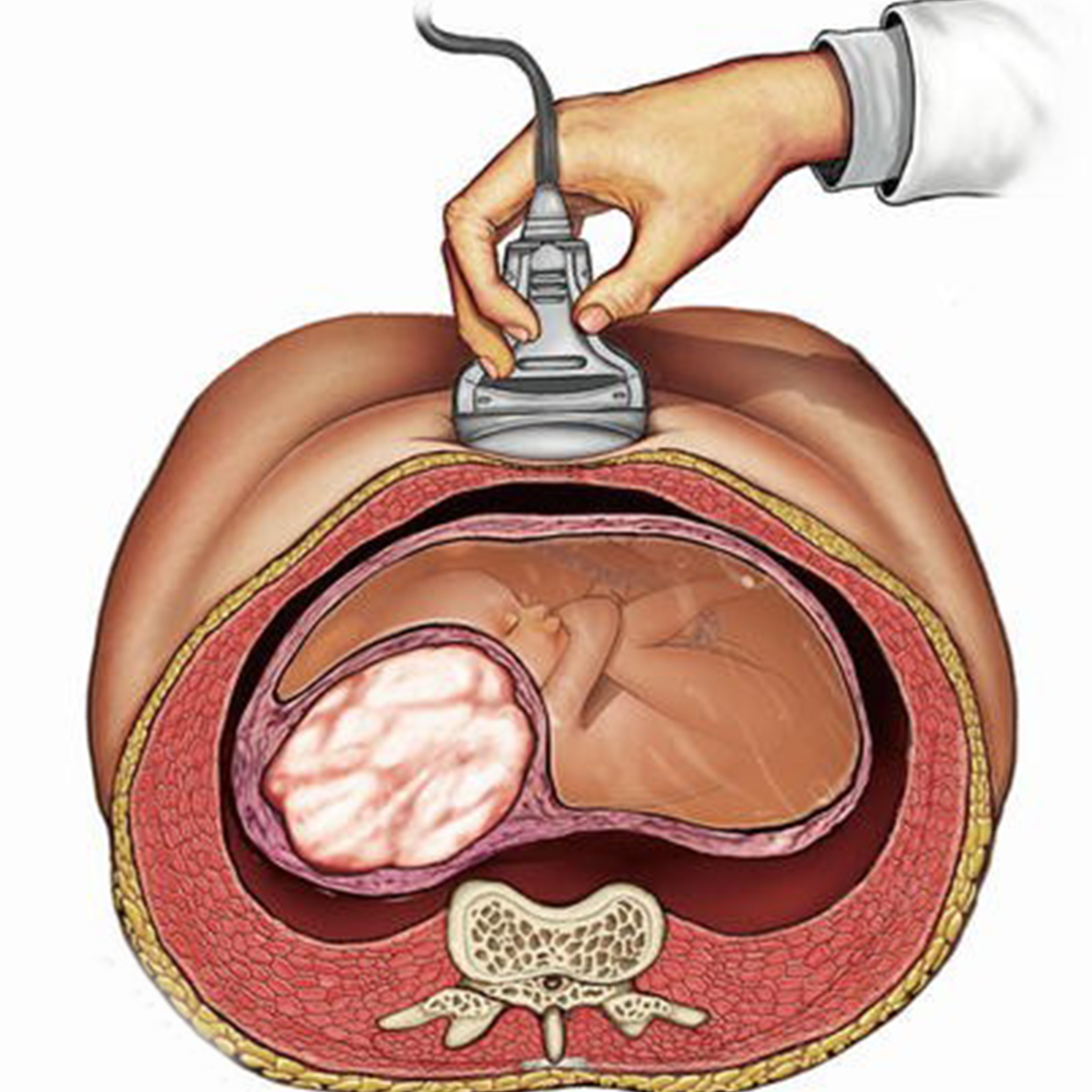 Fibroids in Pregnancy-Best Doctor for Uterine Fibroids in Faridabad