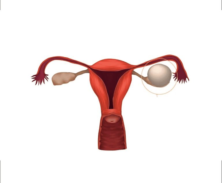 Ovarian Cyst - Ovarian Cyst Removal Surgeon in Faridabad