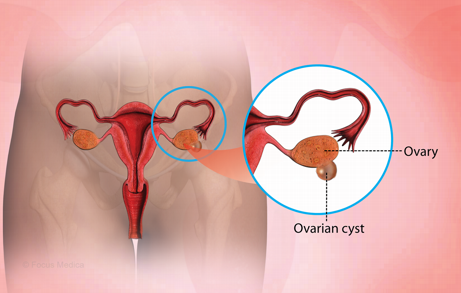 Ovarian Cyst Removal Surgeon in Faridabad-Dr Shweta Mendiratta