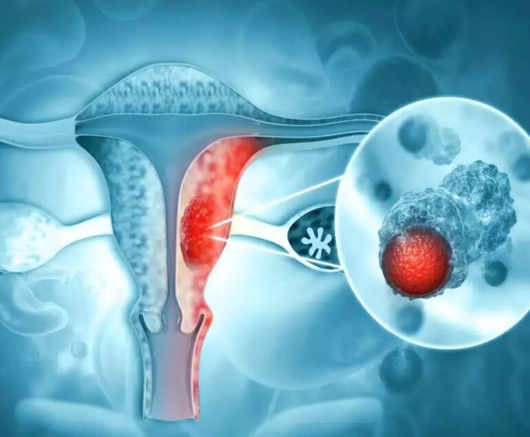 Gynaecological Cancers - Types and Symptoms - Dr Shweta