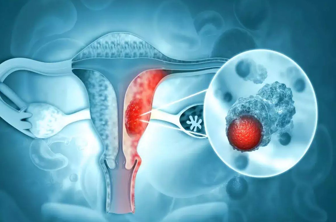 Gynaecological Cancers - Types and Symptoms - Dr Shweta