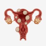 Myomectomy – Effective Solution for Uterine Fibroids