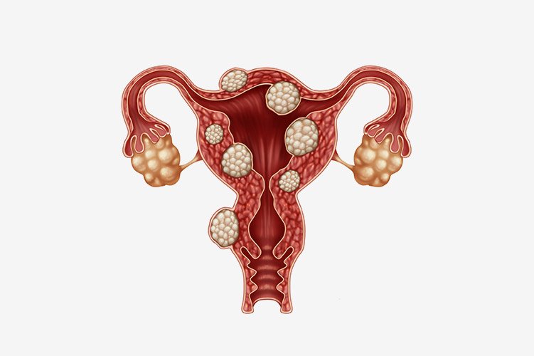 Myomectomy – Effective Solution for Uterine Fibroids