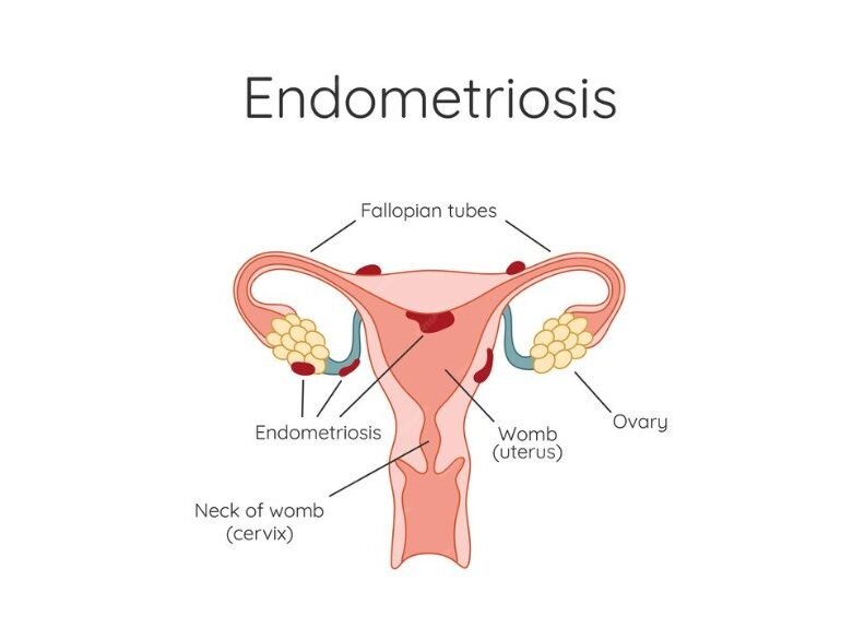 Endometriosis - Best Gynaecologist in Faridabad - Dr Shweta Mendiratta