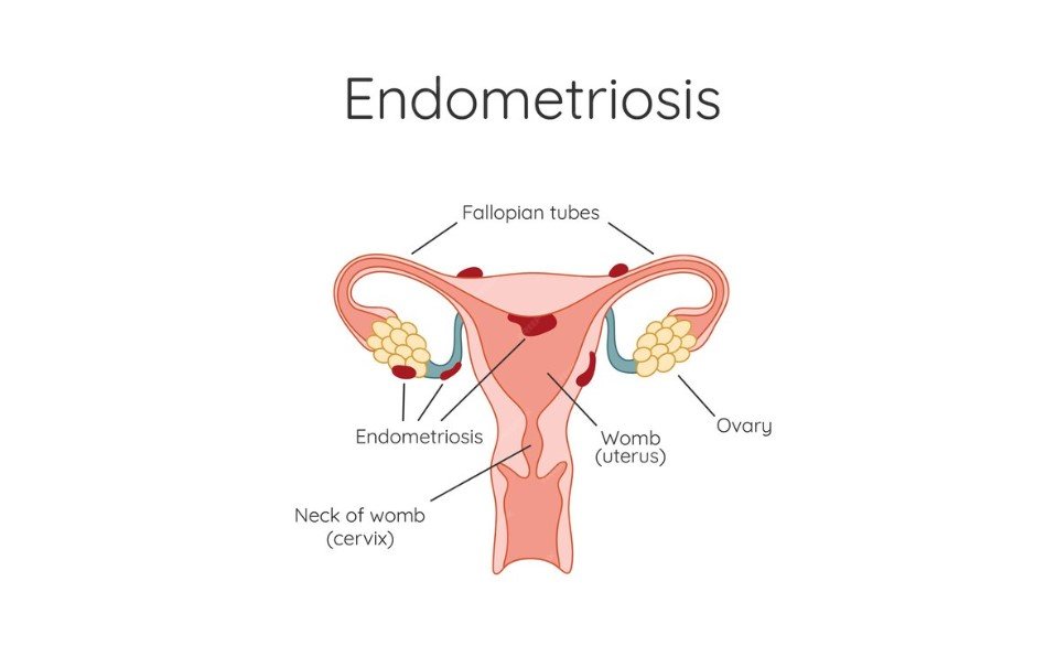 Endometriosis - Best Gynaecologist in Faridabad - Dr Shweta Mendiratta