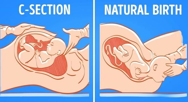 Normal Delivery or C-Section -Expert Guide by Dr Shweta Mendiratta