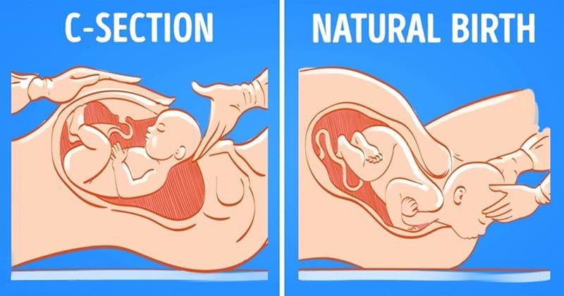 Normal Delivery or C-Section -Expert Guide by Dr Shweta Mendiratta