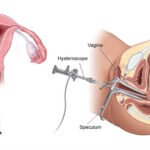 Hysteroscopy in Faridabad — The Test That Changes Everything