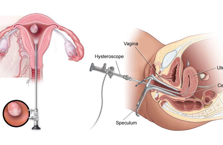 Hysteroscopy in Faridabad — The Test That Changes Everything