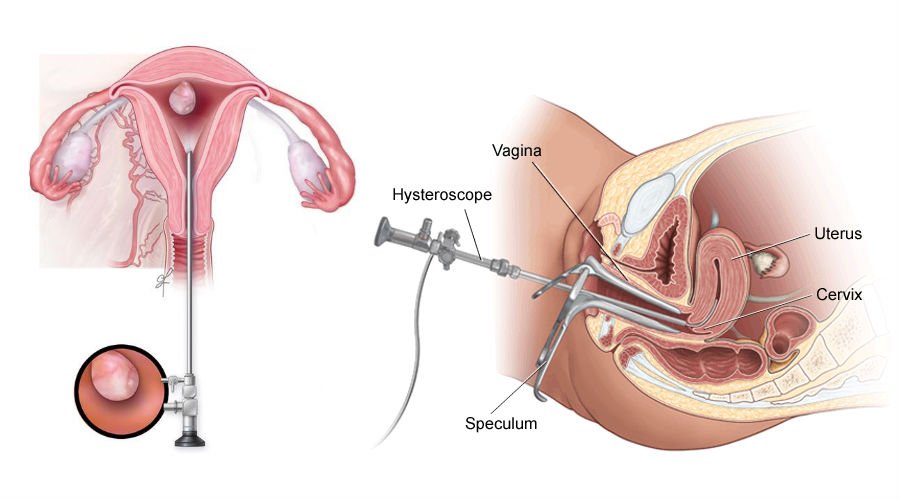 Hysteroscopy in Faridabad — The Test That Changes Everything